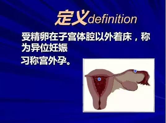 异位妊娠定义示意