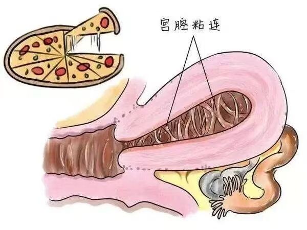 宫腔粘连示意