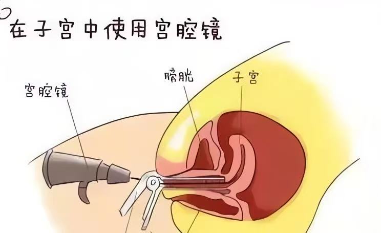 宫腔镜检查示意