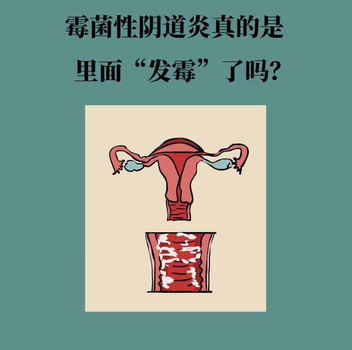 霉菌性阴道炎科普封面